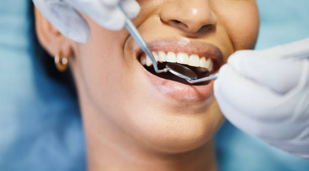 Best Emergency Dentist for Lost Fillings or Crowns in Rosend, LA